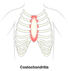 chest pain costochondritis breast causes does ribs musculoskeletal disease heart mean than usually health