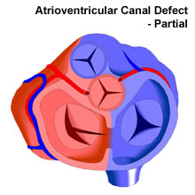 Atrioventricular Canal Partial