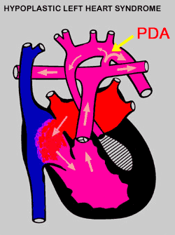 Hypoplastic Left Heart Syndrome