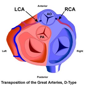 Transposition of the Great Arteries, D-Type